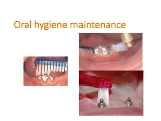 Oral hygiene maintenance
 