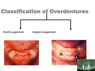 Classification of Overdentures
Tooth supported Implant supported
 