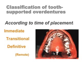 Classification of tooth-
supported overdentures
I. According to time of placement:
Immediate
Transitional
Definitive
(Remote)
 