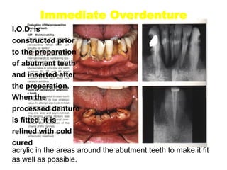Immediate Overdenture
I.O.D. is
constructed prior
to the preparation
of abutment teeth
and inserted after
the preparation.
When the
processed denture
is fitted, it is
relined with cold
cured
acrylic in the areas around the abutment teeth to make it fit
as well as possible.
 