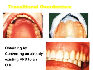 Transitional Overdenture
Obtaining by
Converting an already
existing RPD to an
O.D.
 