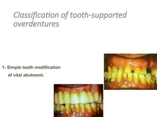 Classification of tooth-supported
overdentures
II. According to design and technique of
abutment preparation:
1- Simple tooth modification
of vital abutment.
 