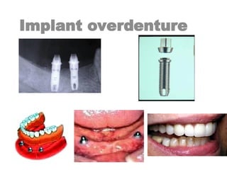 Implant overdenture
 