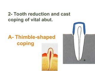 2- Tooth reduction and cast
coping of vital abut.
A- Thimble-shaped
coping
 