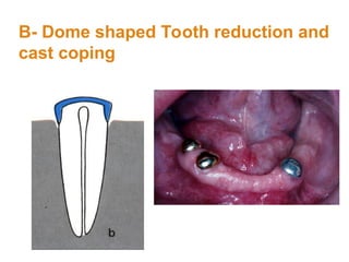 B- Dome shaped Tooth reduction and
cast coping
 
