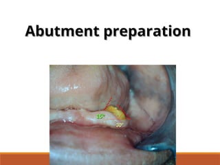 30°
30°
15°
15°
Abutment preparation
Abutment preparation
 