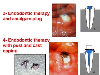 3- Endodontic therapy
and amalgam plug
4- Endodontic therapy
with post and cast
coping
 