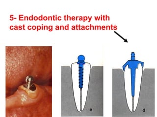 5- Endodontic therapy with
cast coping and attachments
 