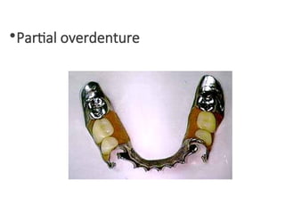 •Partial overdenture
 