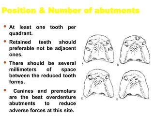 Position & Number of abutments
 At least one tooth per
quadrant.
 Retained teeth should
preferable not be adjacent
ones.
 There should be several
millimeters of space
between the reduced tooth
forms.
 Canines and premolars
are the best overdenture
abutments to reduce
adverse forces at this site.
 