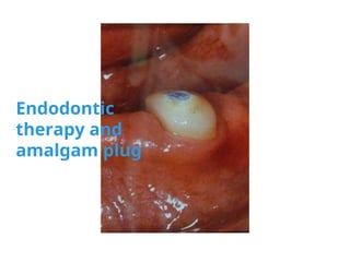 Endodontic
therapy and
amalgam plug
 