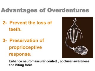 Advantages of Overdentures
2- Prevent the loss of
teeth.
3- Preservation of
proprioceptive
response:
Enhance neuromascular control , occlusal awareness
and biting force.
 