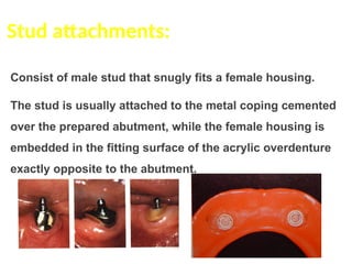 Stud attachments:
Consist of male stud that snugly fits a female housing.
The stud is usually attached to the metal coping cemented
over the prepared abutment, while the female housing is
embedded in the fitting surface of the acrylic overdenture
exactly opposite to the abutment.
 