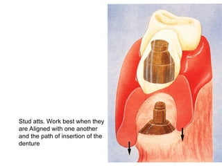Rigid stud
attachments
Stud atts. Work best when they
are Aligned with one another
and the path of insertion of the
denture
 