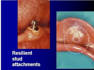 Resilient
stud
attachments
 