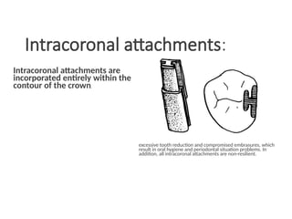 Intracoronal attachments:
Intracoronal attachments are
incorporated entirely within the
contour of the crown.
excessive tooth reduction and compromised embrasures, which
result in oral hygiene and periodontal situation problems. In
addition, all intracoronal attachments are non-resilient.
 