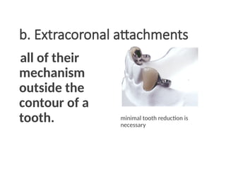 b. Extracoronal attachments
all of their
mechanism
outside the
contour of a
tooth. minimal tooth reduction is
necessary
 