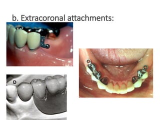 b. Extracoronal attachments:
 
