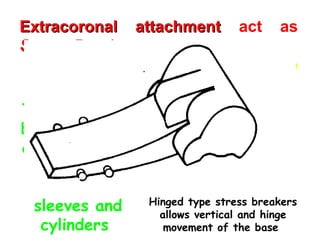 Extracoronal attachment
Extracoronal attachment act as
Stress Breakers
Stress Breakers
RPD having a movable joint between the
direct retainer and the denture base
This joint may
be in the form
of hinges, ball
and socket
devices or
sleeves and
cylinders
Hinged type stress breakers
allows vertical and hinge
movement of the base
 