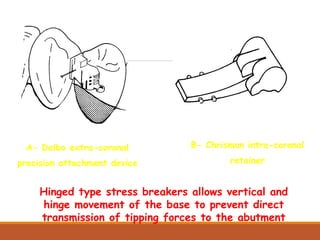 Hinged type stress breakers allows vertical and
hinge movement of the base to prevent direct
transmission of tipping forces to the abutment
A- Dalbo extra-coronal
precision attachment device
B- Chrisman intra-coronal
retainer
 