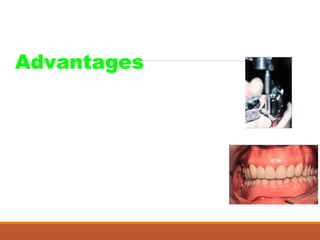 Advantages
• Esthetics
• Hygiene
• Stress distribution:
Deep rest,
Directs stress along long axis
• Single path of movement
 