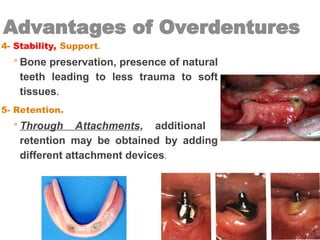Advantages of Overdentures
4- Stability, Support.
◦ Bone preservation, presence of natural
teeth leading to less trauma to soft
tissues.
5- Retention.
◦ Through Attachments, additional
retention may be obtained by adding
different attachment devices.
 