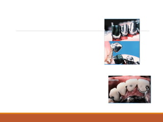 Not Easy constructed
Parallelism
Casting
Processing
Needs Tissue base impression
Relating Base to teeth
 