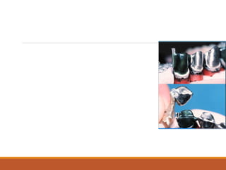 Contraindications
Short clinical crowns
Large pulps
Dexterity problems
Bruxers?
 
