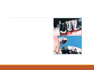 Not Easy constructed
Parallelism Casting
Processing acrylic
Tissue base impression
Relating Base to teeth
Contraindications Short clinical crowns Large pulps
Dexterity problems
Bruxers?
 