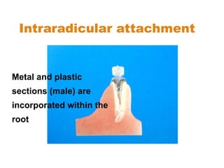 Intraradicular attachment
Metal and plastic
sections (male) are
incorporated within the
root
 