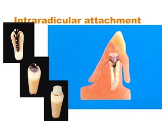 Intraradicular attachment
 