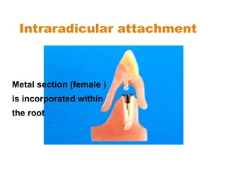 Intraradicular attachment
Metal section (female )
is incorporated within
the root
 