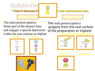 *
* Chee & Donavan (1993),
Chee & Donavan (1993), classified stud attachments into:
classified stud attachments into:
Intra-radicular Extra-radicular
* The male portion (patrix)
forms part of the denture base
and engages a special depression
within the root contour or implant
* The male portion (patrix)
projects from the root surface
of the preparation or implant.
* Logic * Zest
* Rotherman attachment
* Dalla Bona
* Micro
Fix
 