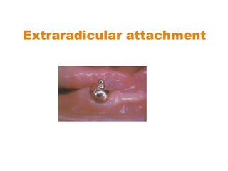 Extraradicular attachment
 