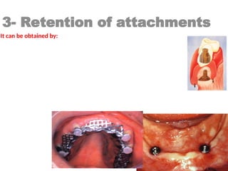 3- Retention of attachments
It can be obtained by:
frictional.
mechanical.
frictional and mechanical.
Magnets.
 