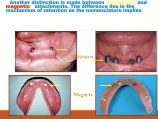 Another distinction is made between mechanical and
magnetic attachments. The difference lies in the
mechanism of retention as the nomenclature implies.
Magnets
Keepers
 
