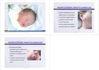 MUMPS (EPİDEMİC PAROTİTİSMUMPS (EPİDEMİC PAROTİTİS‐‐KABAKULAK)KABAKULAK)
 Viral bir enfeksiyonun neden 
olduğu bulaşıcı bir hastalıktır
 N auricularis magnus fascia N. auricularis magnus, fascia 
parotidea ve üzerini örten 
deriden duyu taşır
 Bu fibröz kılıfın akut şişmesi 
Kabakulak ağrısının sebebidir
MUMPS (EPİDEMİC PAROTİTİSMUMPS (EPİDEMİC PAROTİTİS‐‐KABAKULAK)KABAKULAK)
 Bu hastalık ile birlikte 
puberteden sonra, testisler veya 
overlerde enflamasyon 
görülebilir ve steriliteye neden 
olabilir
 Çocukların küçük yaşlarda bu 
enfeksiyonu geçirmesi riskienfeksiyonu geçirmesi riski 
azaltır
 