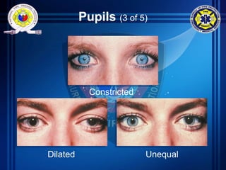 Pupils (3 of 5)
Constricted
Dilated Unequal
 