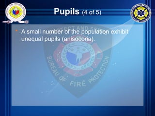 Pupils (4 of 5)
• A small number of the population exhibit
unequal pupils (anisocoria).
 
