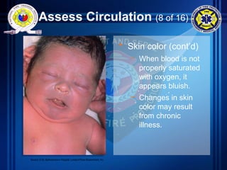 Assess Circulation (8 of 16)
• Skin color (cont’d)
– When blood is not
properly saturated
with oxygen, it
appears bluish.
– Changes in skin
color may result
from chronic
illness.
Source: © St. Bartholomew’s Hospital, London/Photo Researchers, Inc.
 