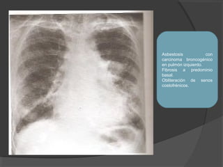 Patologia instersticial pulmonar