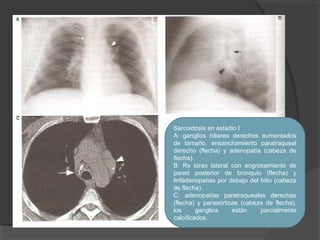 Patologia instersticial pulmonar
