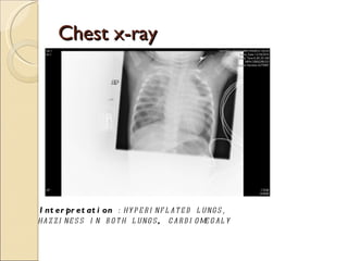 Chest x-ray Interpretation  :hyperinflated lungs, hazziness in both lungs ,  cardiomegaly       
