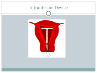 Intrauterine Device 