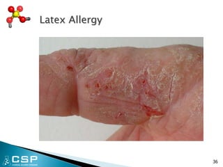 Latex Allergy
36
 
