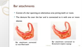 11/09/2025 103
Bar attachments
 Consist of a bar spanning an edentulous area joining teeth or roots
 The denture fits over the bar and is connected to it with one or more
sleeves
Bar attachment connected
to root filled teeth
Bar attachment connected to
Branemark implant copings
 