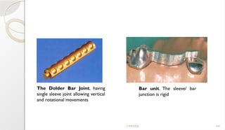 11/09/2025 104
The Dolder Bar Joint, having
single sleeve joint allowing vertical
and rotational movements
Bar unit. The sleeve/ bar
junction is rigid
 