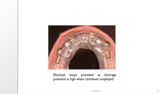 11/09/2025 106
Occlusal stops provided as leverage
potential is high when cantilever employed
 