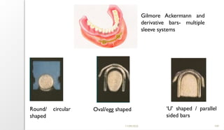 11/09/2025 109
Round/ circular
shaped
Oval/egg shaped ‘U’ shaped / parallel
sided bars
Gilmore Ackermann and
derivative bars- multiple
sleeve systems
 