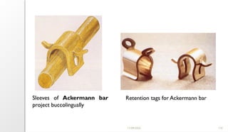 11/09/2025 110
Sleeves of Ackermann bar
project buccolingually
Retention tags for Ackermann bar
 